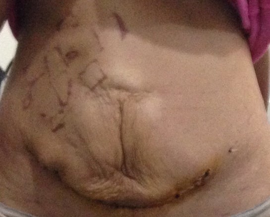 My tummy tuck experience gone wrong (Photo)