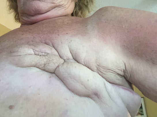double mastectomy scars