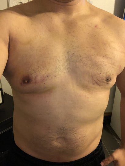 Why Am I Noticing Asymmetrical Healing Swelling 2 Weeks Post Gynecomastia Surgery Photo