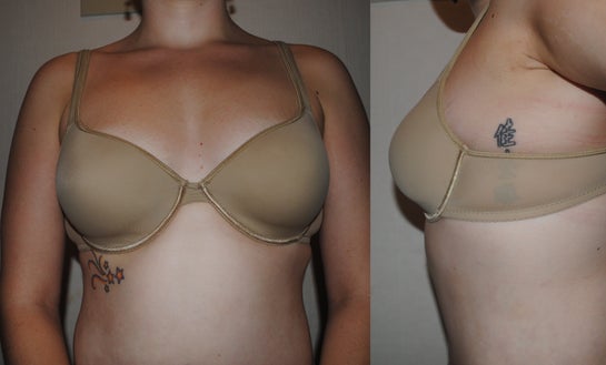 How Can I Guarantee a C Cup After Breast Lift With Augmentation?