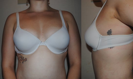 How Can I Guarantee a C Cup After Breast Lift With Augmentation?