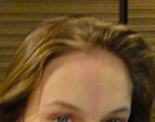Stork Bite Birthmark Forehead