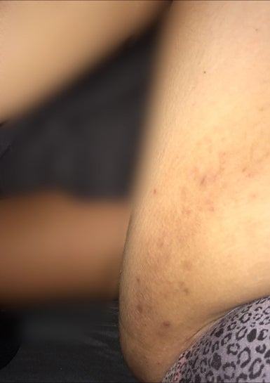 Dark patches/scars on inner thigh, is there anyone who knows where i can  bleach and fix my inner thighs? (Photos)