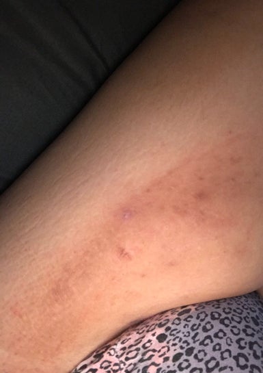 Dark patches/scars on inner thigh, is there anyone who knows where
