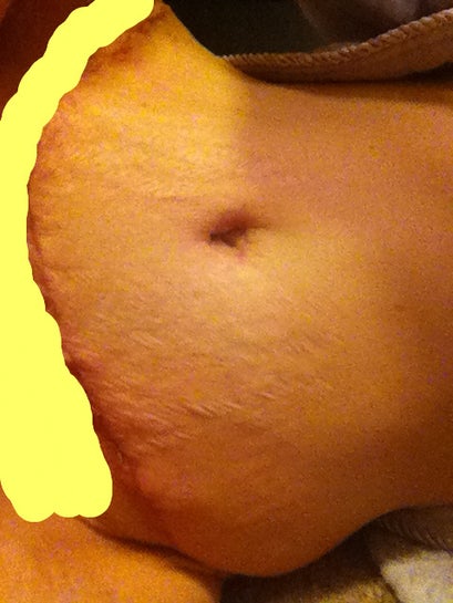 Is It Normal to Have Skin Hang Like This After a Tummy Tuck when