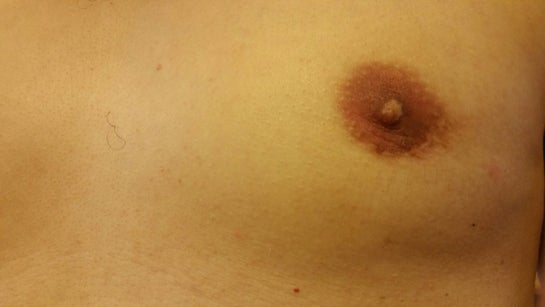 Weird bumps around nipples after keyhole .. what are they : r