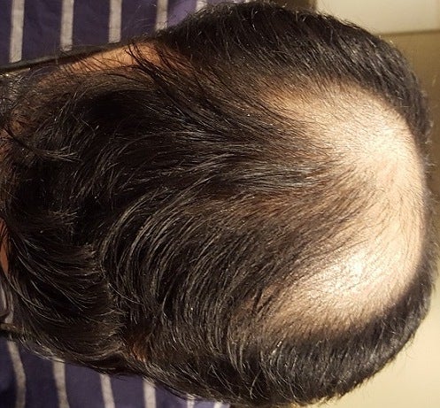 Considering this level of baldness is 28 too young to have a