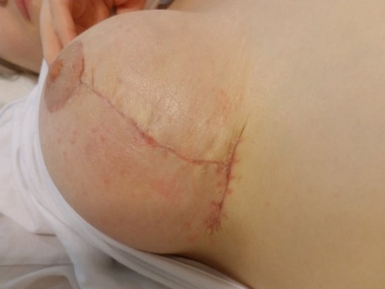 Large, red and raised bump on breast after augmentation. What is it, and  should I be concerned? (Photo)
