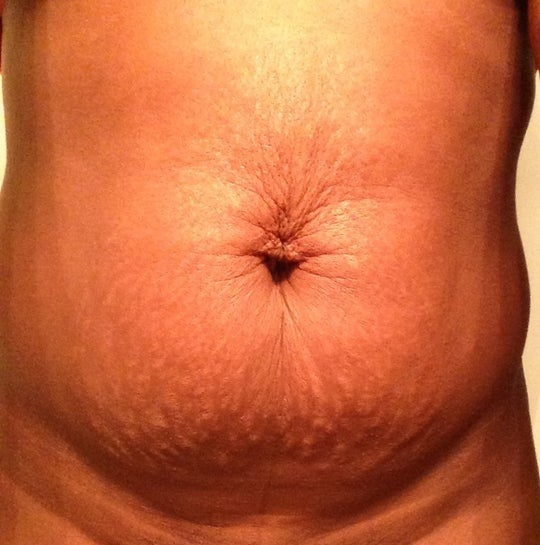 Is it normal for my lower stomach and top part of my mons pubis to feel  hard like a rock after tummy tuck? (Photo)