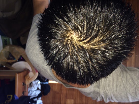 A case study of managing male pattern baldness with a holistic treatment –  Traya