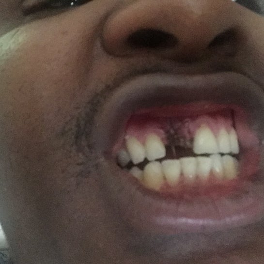 Is My Gum Healing Properly? Why Are The Stitches Coming Out Before Time!  (Photos)