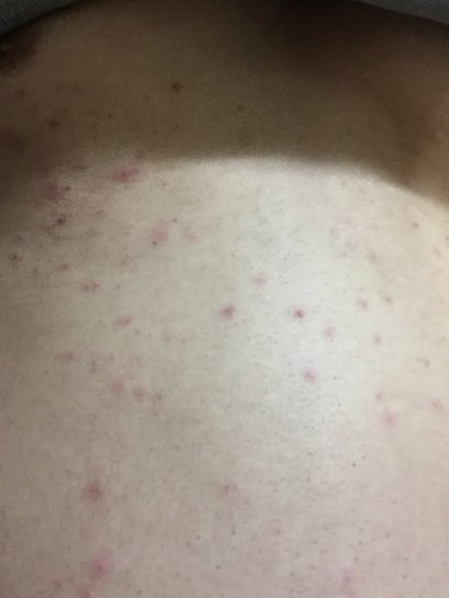 Acne red bumps post Laser Hair Removal is this permanent photos