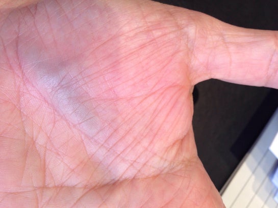 What's the problem a vein in palm get swollen? Since 6 Months i can feel it every now and (photos)