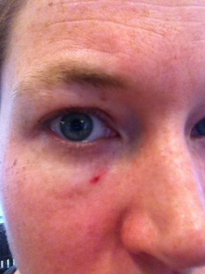 I Have a Blood Blister Formed over a Capillary Under my Eye and