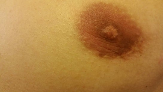 On white nipple male bump Painful Lump