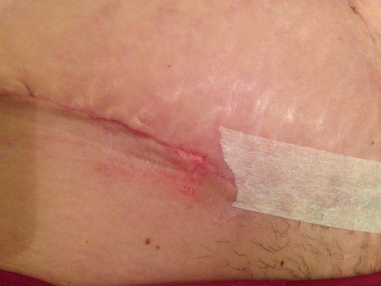 How to use micropore tape on a scar?