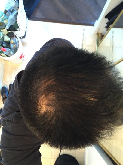 Can a 22 Year Old have a Hair Transplant in India