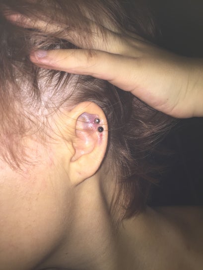 I Got My Cartilage Pierced Double Piercing About 5 Days Ago It Bruised Now It S Swollen Red Sore And Hot To Touch Photo