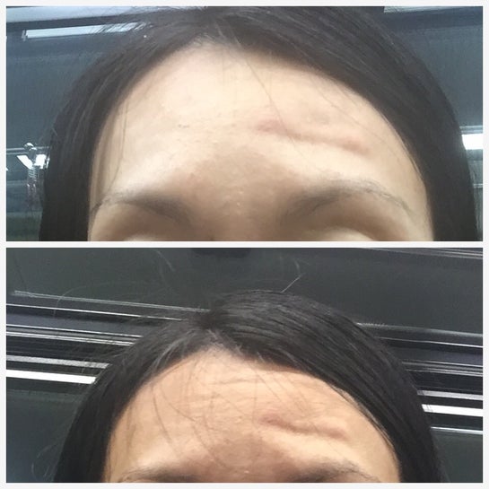 Big Lump On Forehead After Sculptra It S Ugly And Painful When Massaging What Can I Do Photo