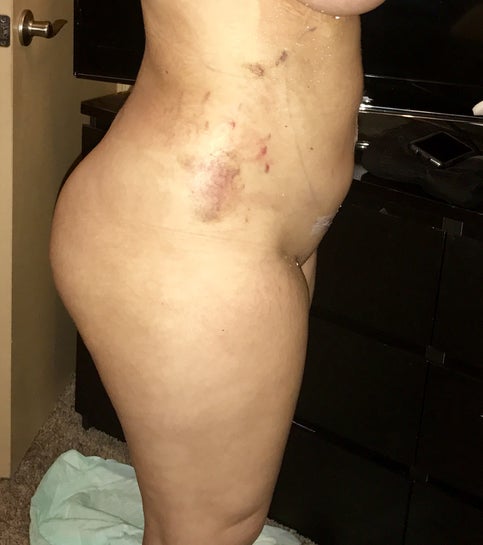 How long do I HAVE to wear my compression garment after Lipo? (photos)