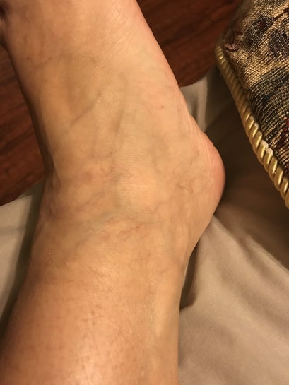 Can A Pedicure Aggravate Varicose Veins On The Ankle Foot Increased Tingling Since I Went My Legs Look Like I M 70 Photo