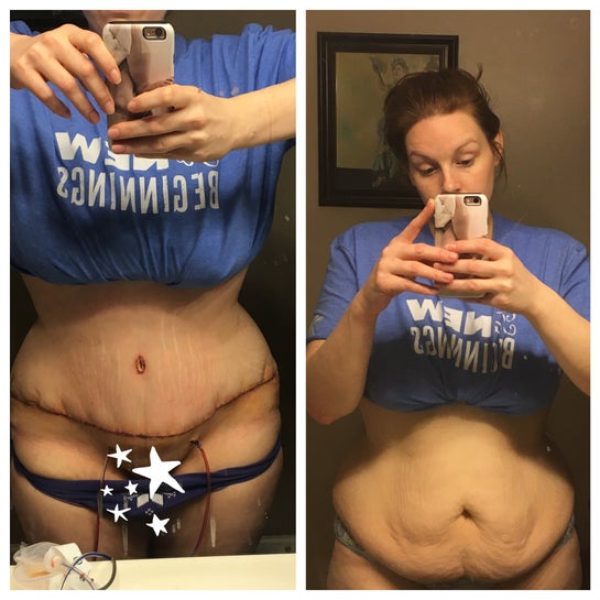 5 days post-op extended TT: What is this burning sensation in my groin?  (photos)