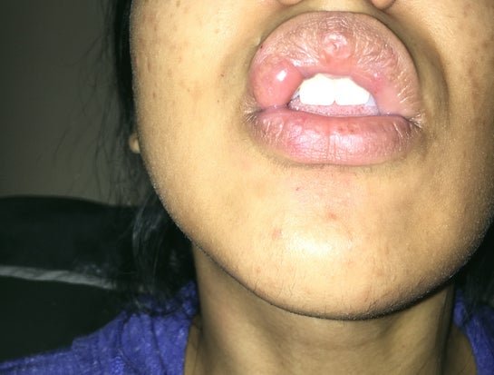 Big Bubble On Lip After Anesthesia? (Photos)