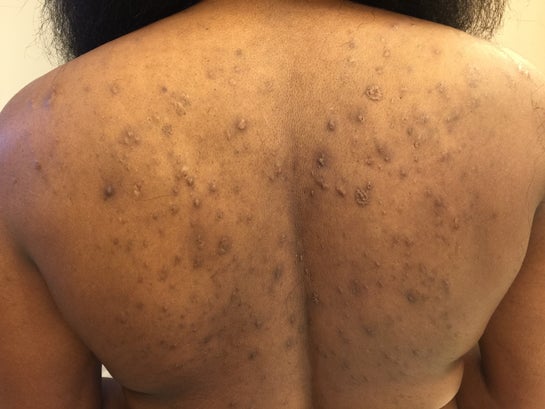acne scars on back