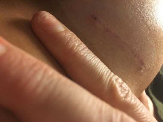 1 Month Post Op Ba Stitches Sticking Out Of Incision Photos