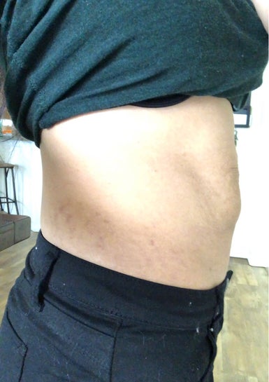 Visible scar tissue hard lump after inner thigh lipo 2 months ago? (Photos)