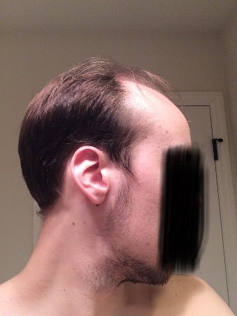 Getting A Hair Transplant At 21 22 Photo