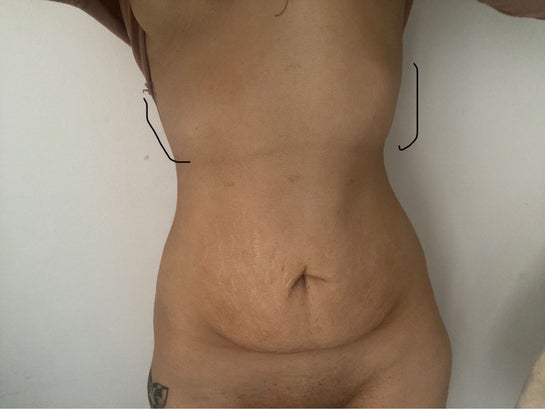PDF] Breast reconstruction with reverse mini abdominoplasty