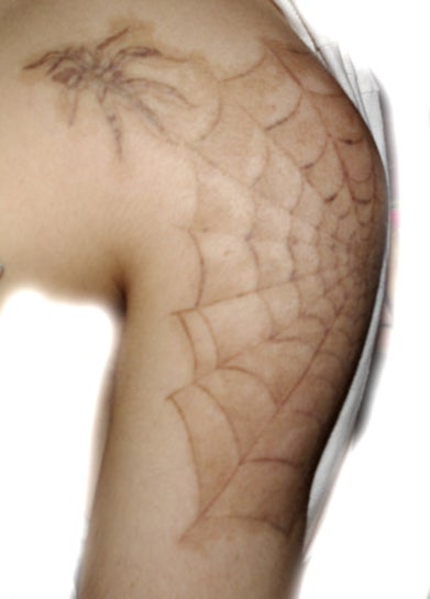 Tattoo Removal in Epsom | Tattoo Removal Near Me