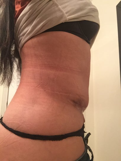 I'm 8 weeks post op with my tummy tuck. How much of my abdominal
