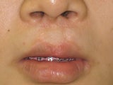 Lip Surgery Before & After Pictures - RealSelf