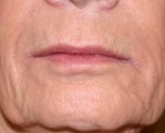 Restylane Before & After Pictures - RealSelf