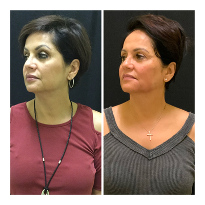 Liquid Facelift before and after photo