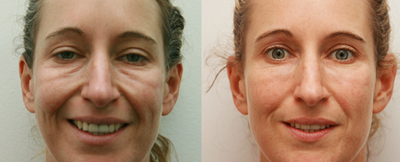 Dermal Fillers before and after photo