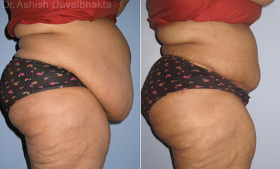 Tummy Tuck before and after photo