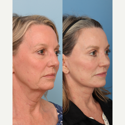 Brow Lift before and after photo