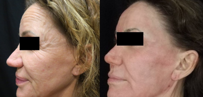 CO2 Laser before and after photo