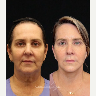 Neck Lift before and after photo