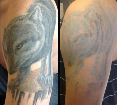 Laser Tattoo Removal  New Day Aesthetic  Hood River OR