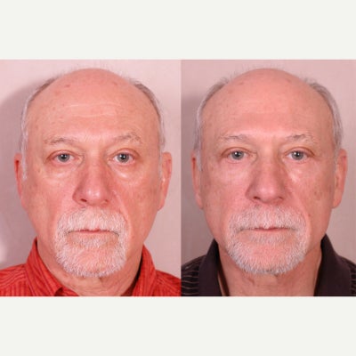 Eyelid Surgery before and after photo