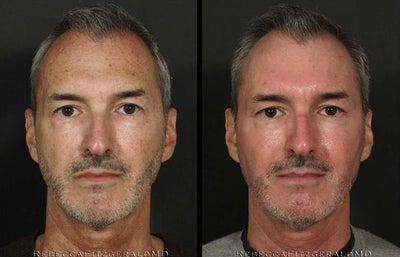 eMatrix before and after photo