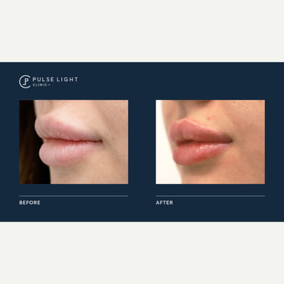 Dermal Fillers before and after photo