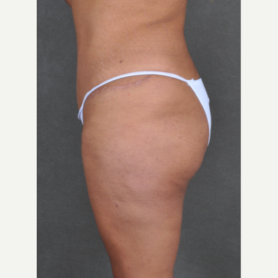 Planning your Brazilian Butt Lift - Omaha Liposuction by Imagen