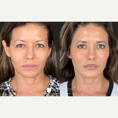 Bellafill before and after photo