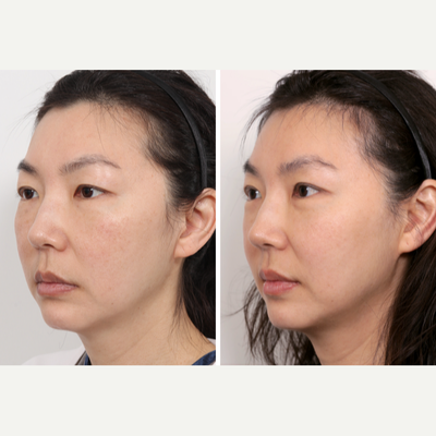 Brow Lift before and after photo