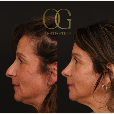 Rhinoplasty before and after photo